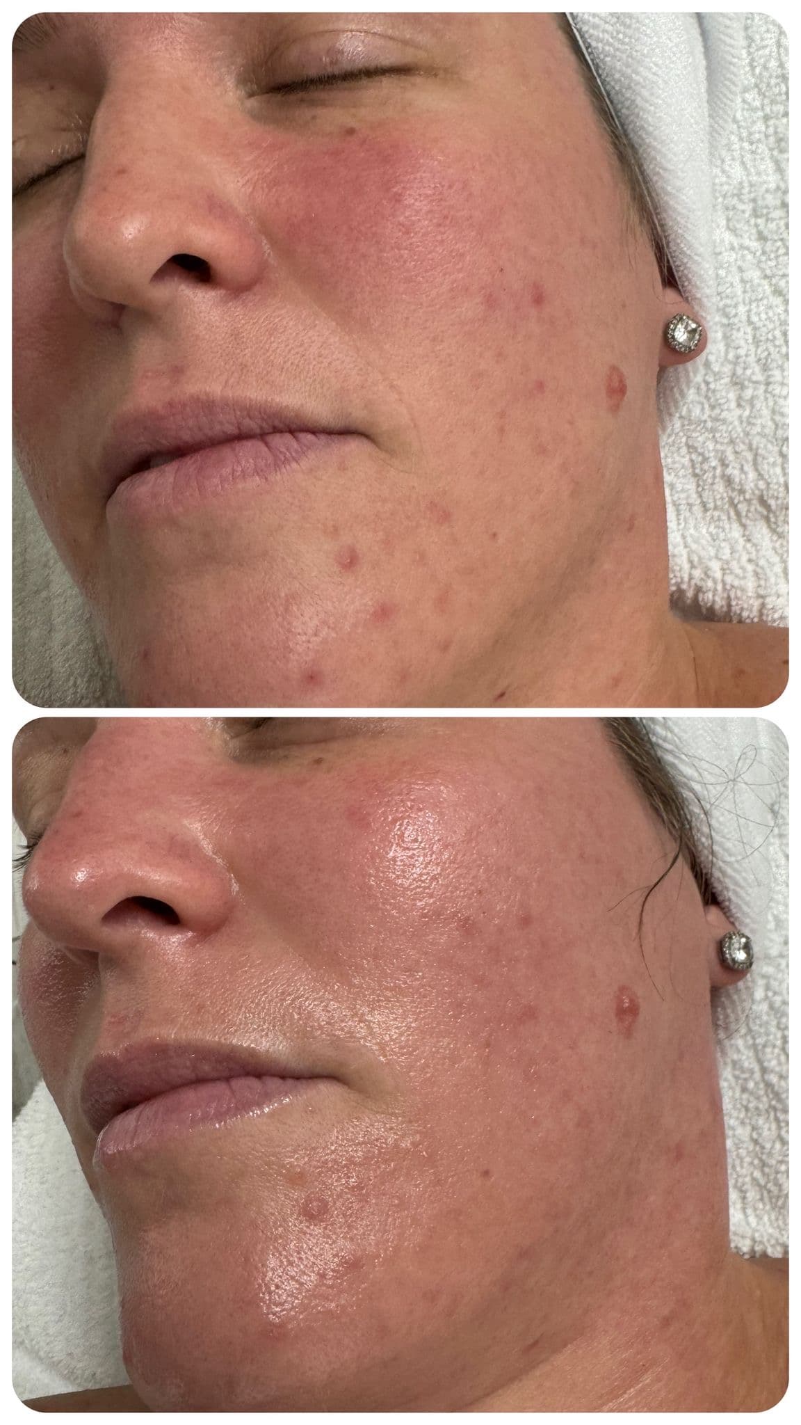 Deep pore cleansing facial result — clarified pores, calmer redness, smoother skin texture