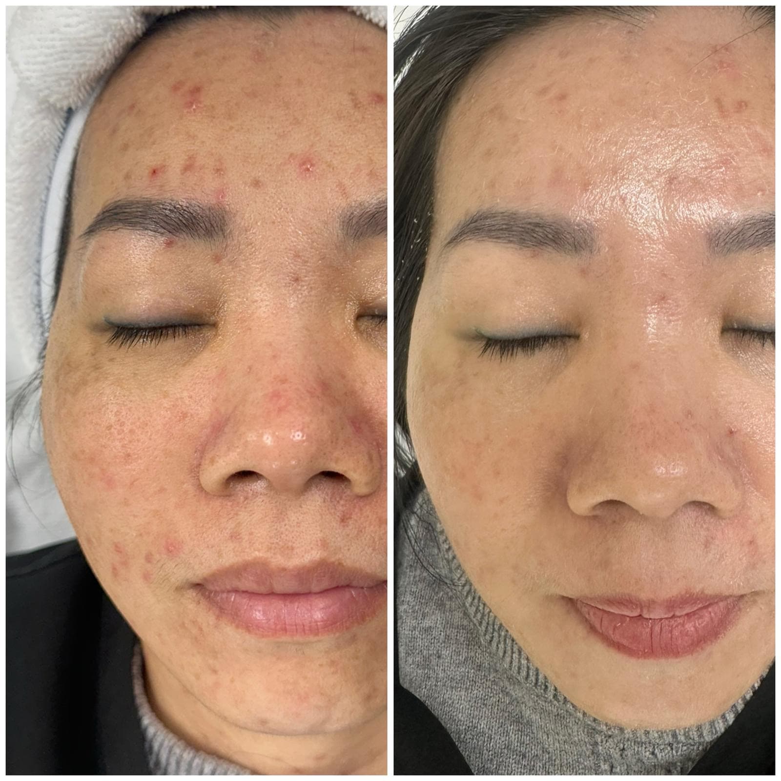 Hydra Facial before-and-after — clearer, brighter skin after multiple sessions