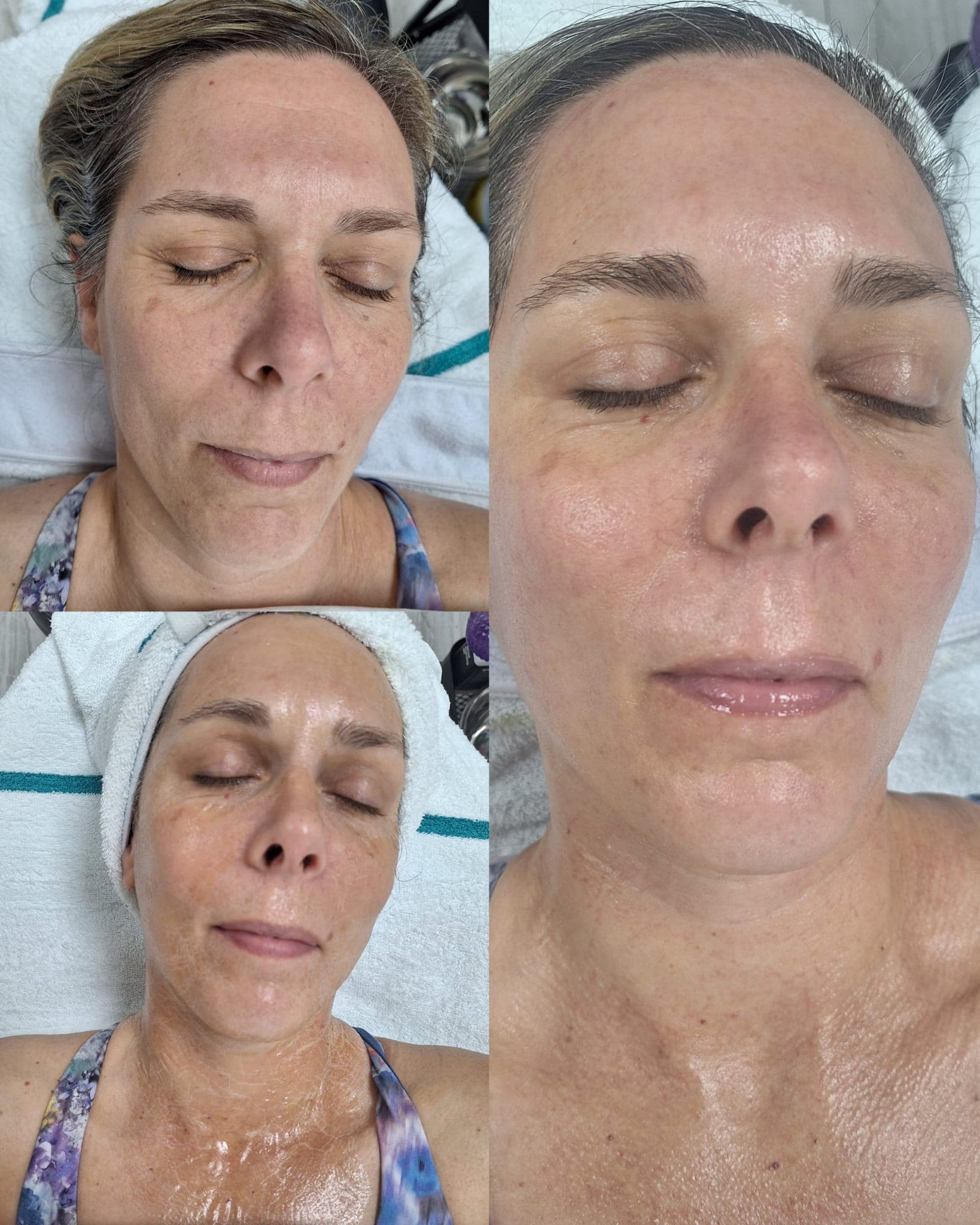 Anti-aging treatment result at Glow & Thread — visibly firmer, smoother, more radiant skin